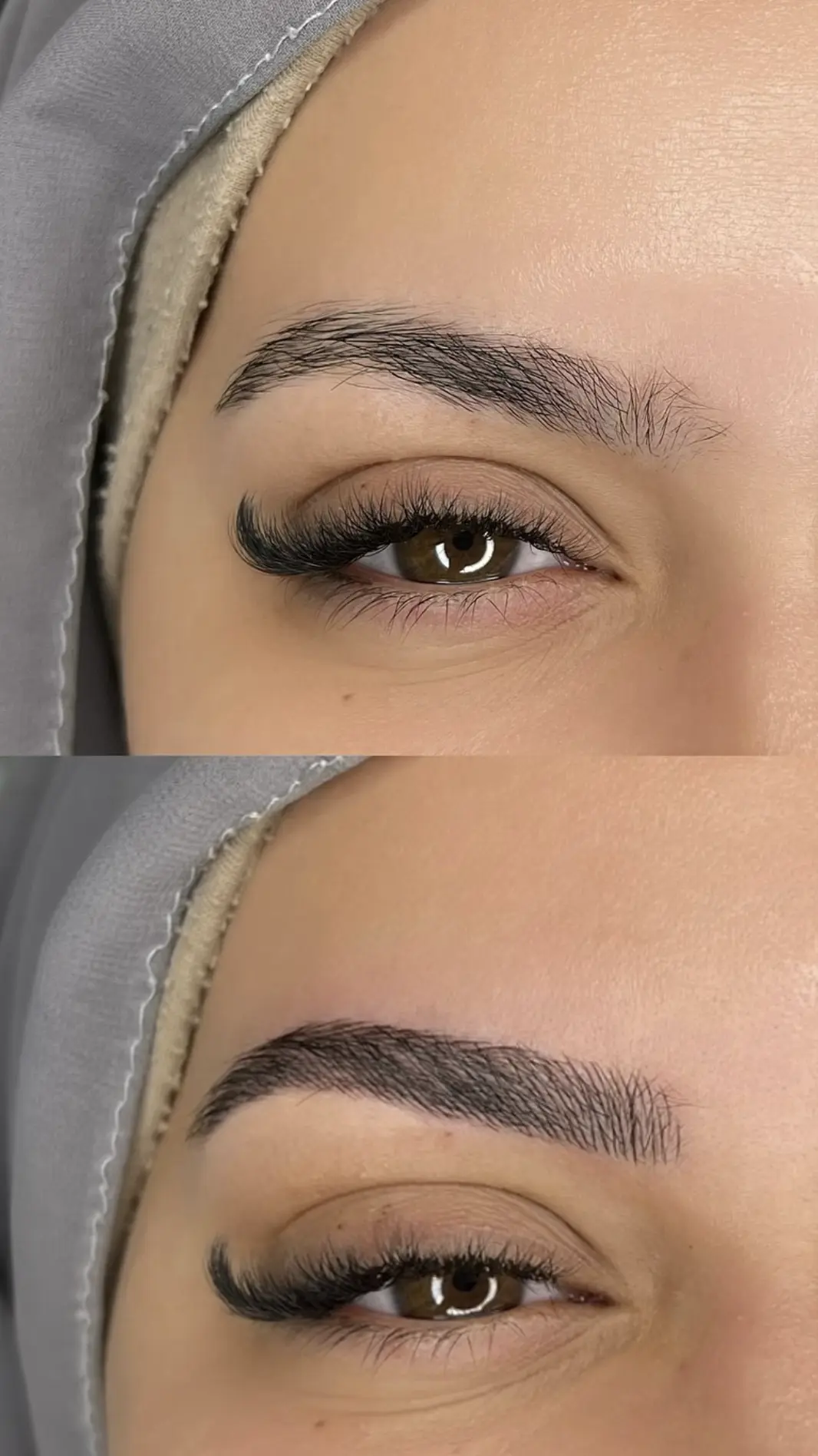 brow mapping with botox